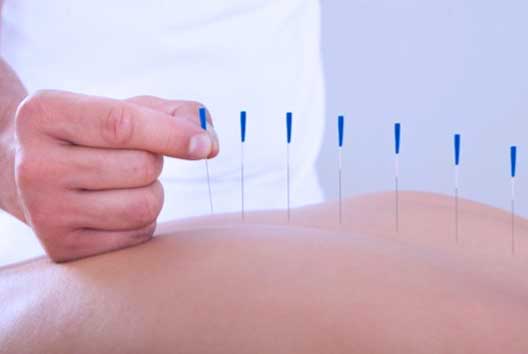 Nadeln werden in Akupunkturpunkte gestochen